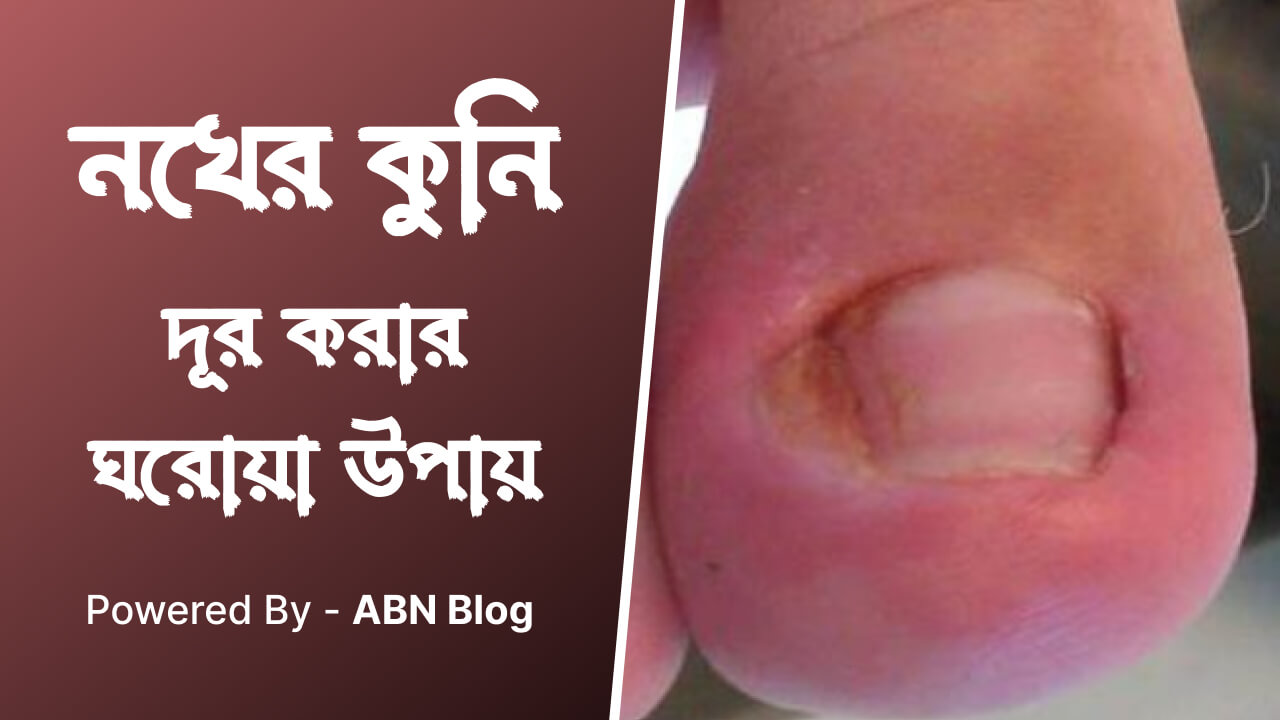 নখের কুনি দূর করার ঘরোয়া উপায়